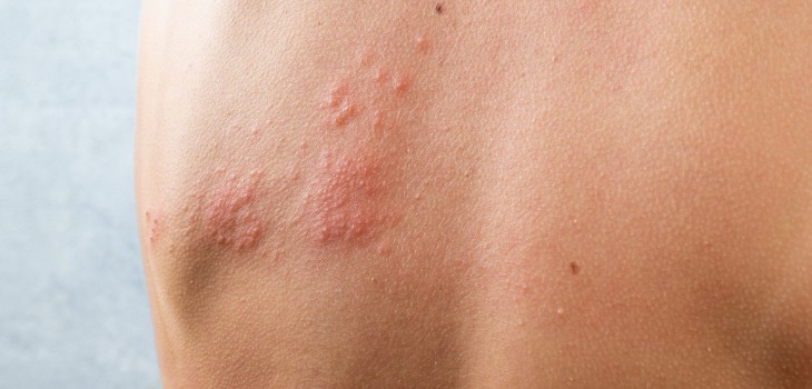Urticaria solară: Ce ascunde reacția alergică declanșată de soare?