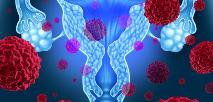 Pachet Scor ROMA în cancerul ovarian - Bucuresti